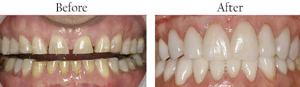 West Hempstead Before and After Invisalign