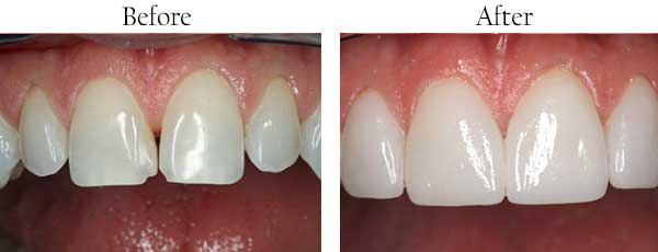 Garden City Before and After Braces