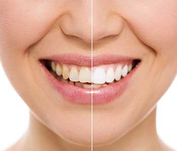 Teeth Whitening in West Hempstead