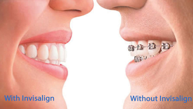 Invisalign West Hempstead