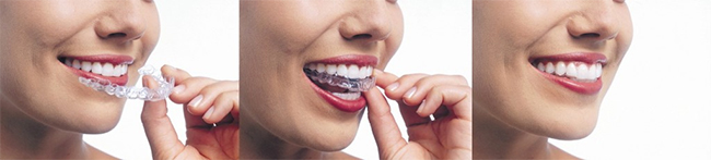 Invisalign in West Hempstead