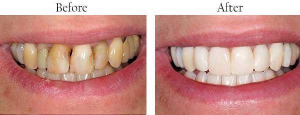 West Hempstead Before and After Invisalign