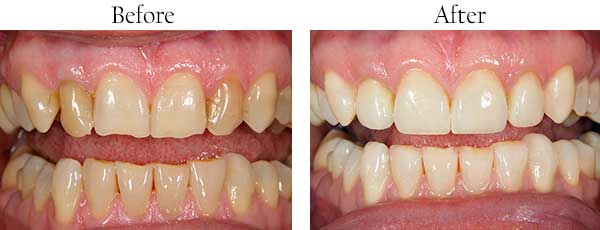 Garden City Before and After Braces